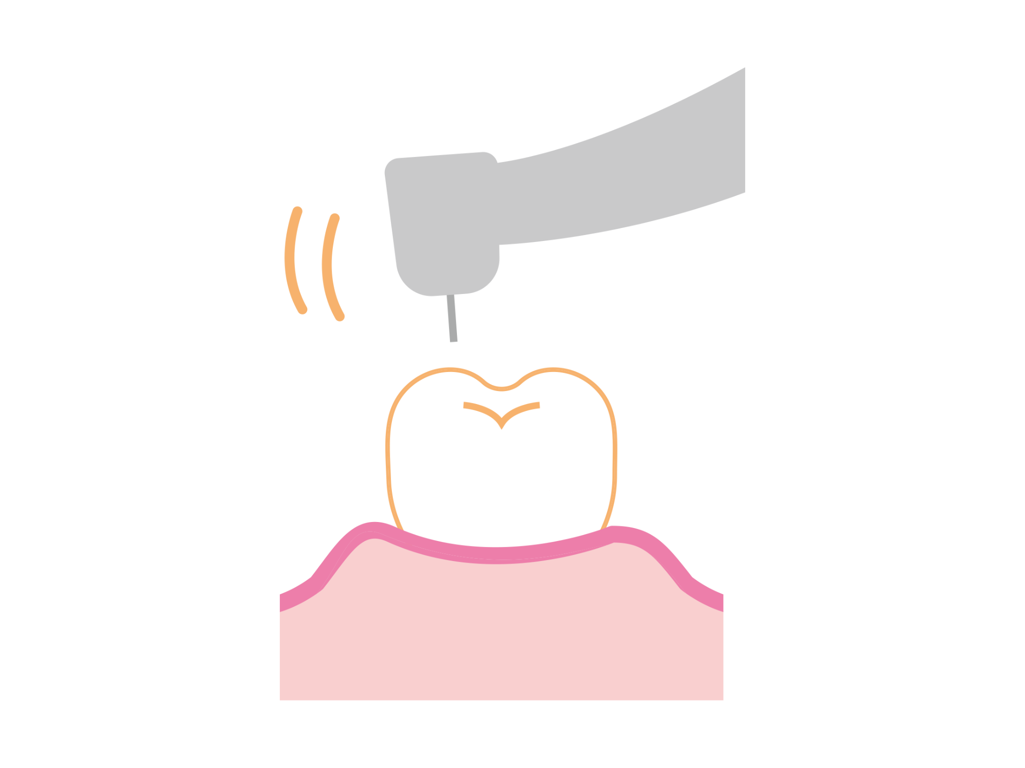 歯の治療のイメージ