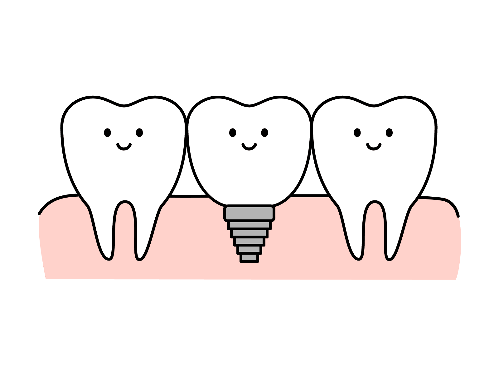 インプラントのある口腔内のイメージ