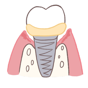 周りに汚れが溜まりやすいインプラント