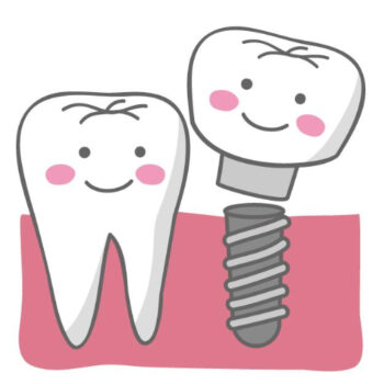 インプラントの被せ物・ネジ・部品のゆるみや破損