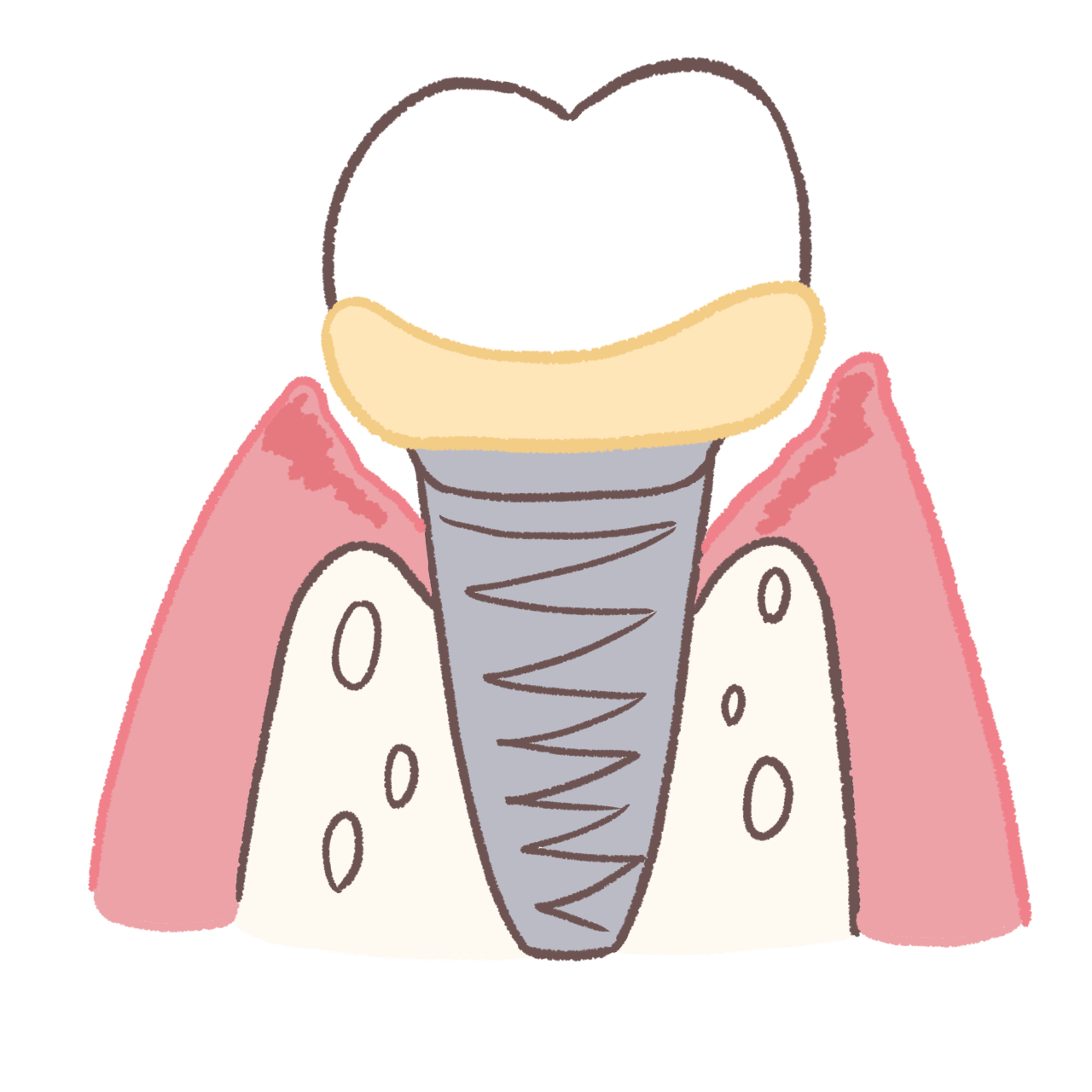 インプラント周辺が炎症を起こした様子