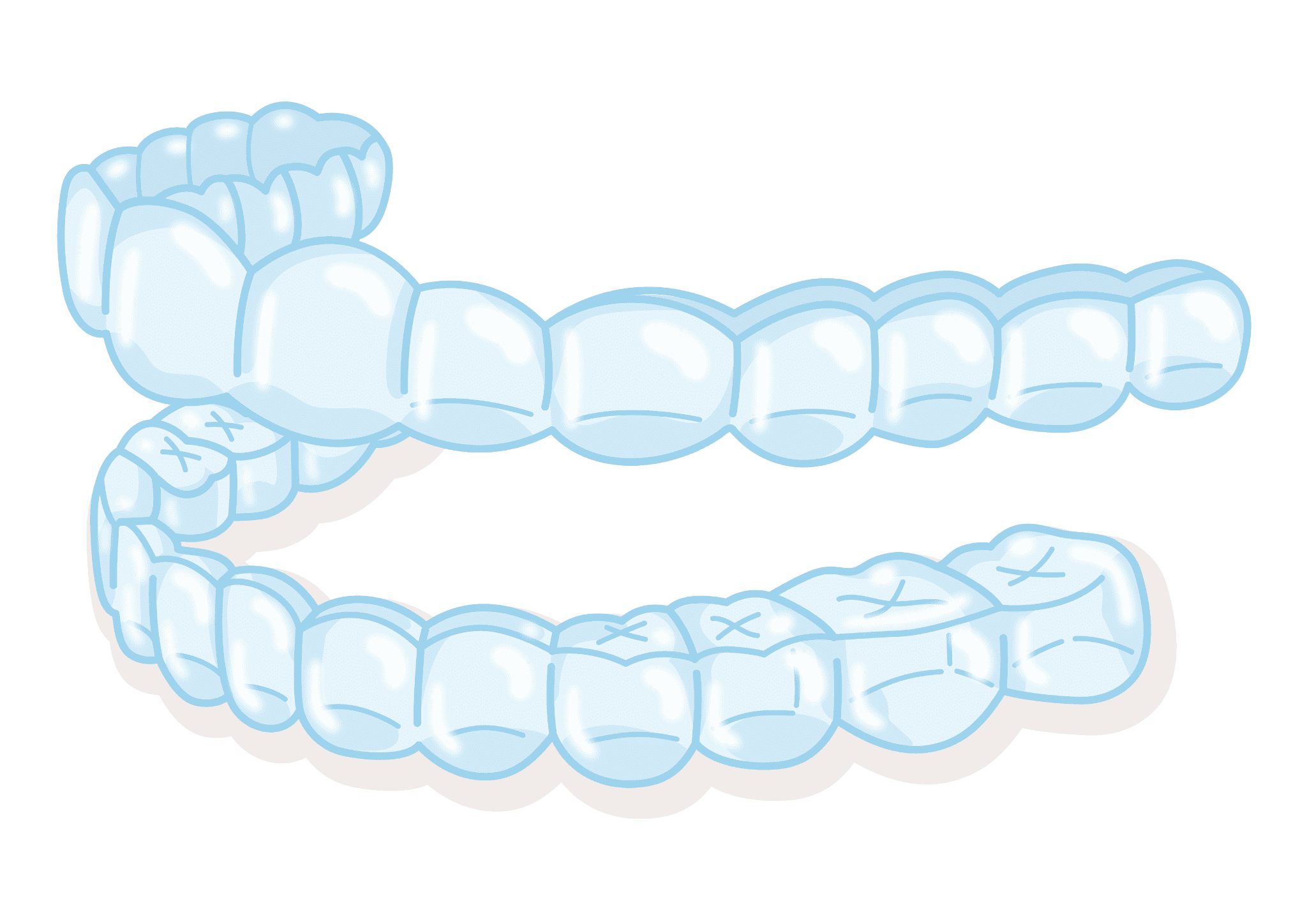 インプラントの負担軽減に使用するマウスピース