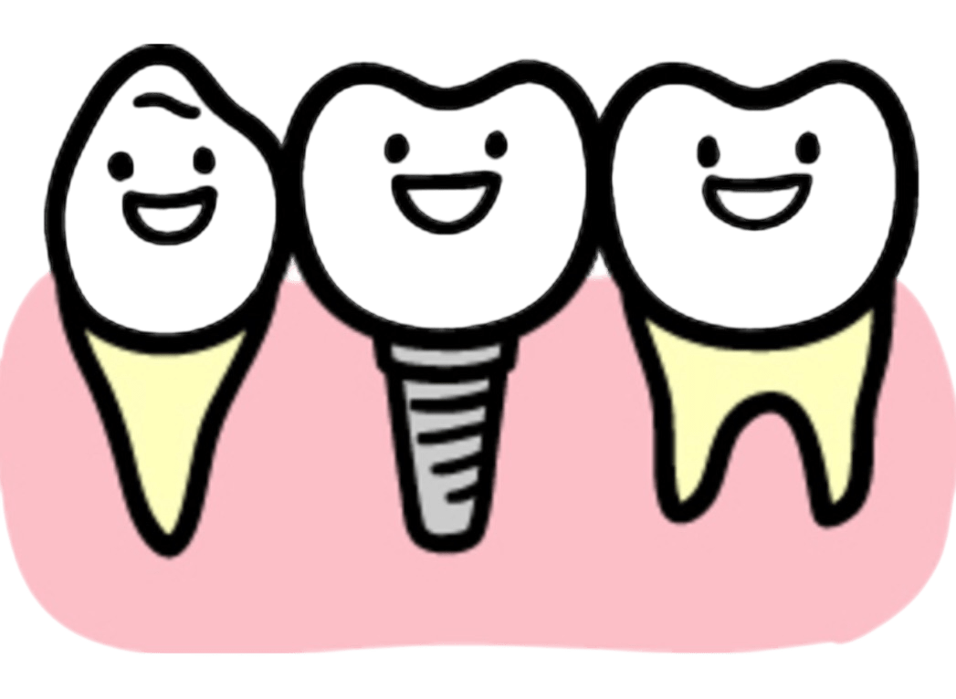 インプラントのイメージ
