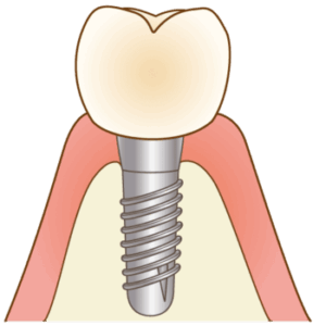 インプラント治療をした歯茎