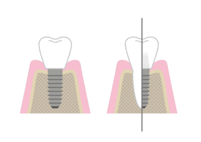 インプラントと天然歯の境目