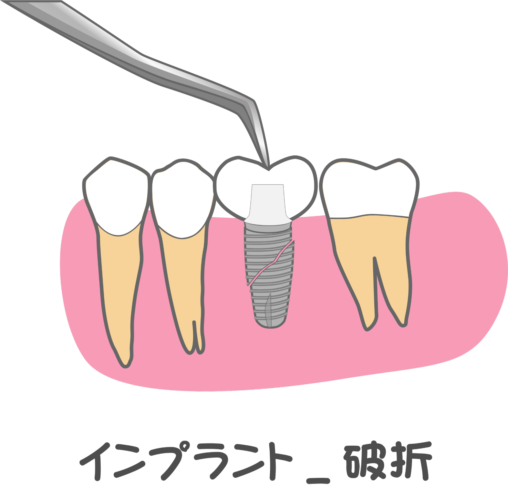 破折したインプラント
