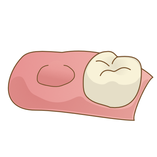 親知らずを抜歯した後の歯茎